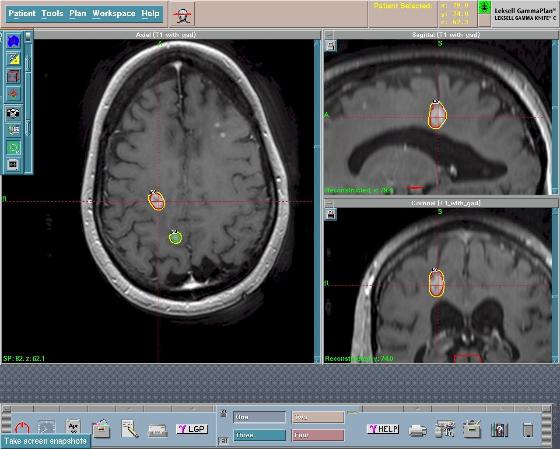 Brain Tumors - Gamma Knife Prep